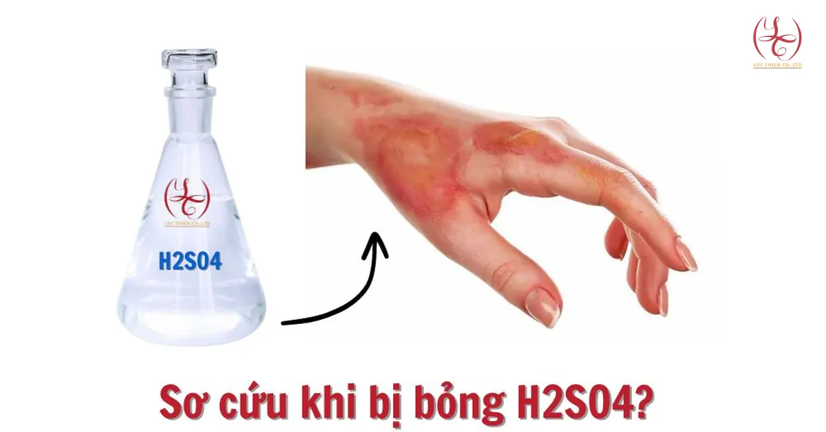 Cách sơ cứu khi bị bỏng Acid sulfuric H2SO4