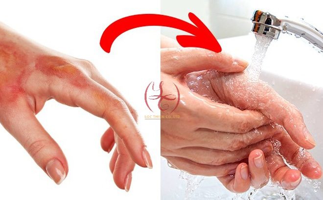 sơ cứu khi bị bỏng acid sulfuric